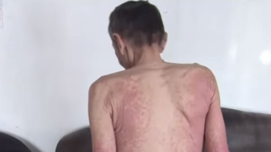 Больной псориазом заразился гепатитом и отказался лечиться в Акмолинской области 